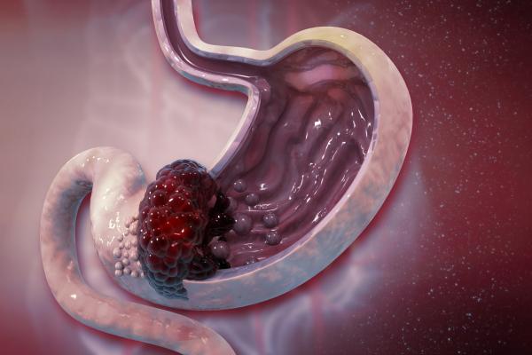 进展期胃癌是什么？严重吗