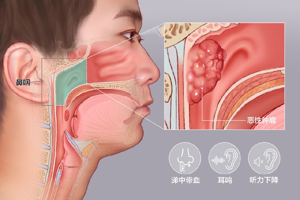 淋巴瘤为何难以康复？如何尽早排查？